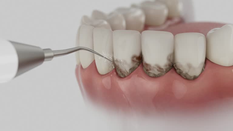 Trusted Wisdom Tooth Removal service in Lame Deer, MT - Dentist Open Now